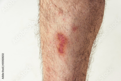 Skin injury after falling from a motorcycle on a man's leg. Skin lesions on the man's body. Abrasion and trauma on white skin