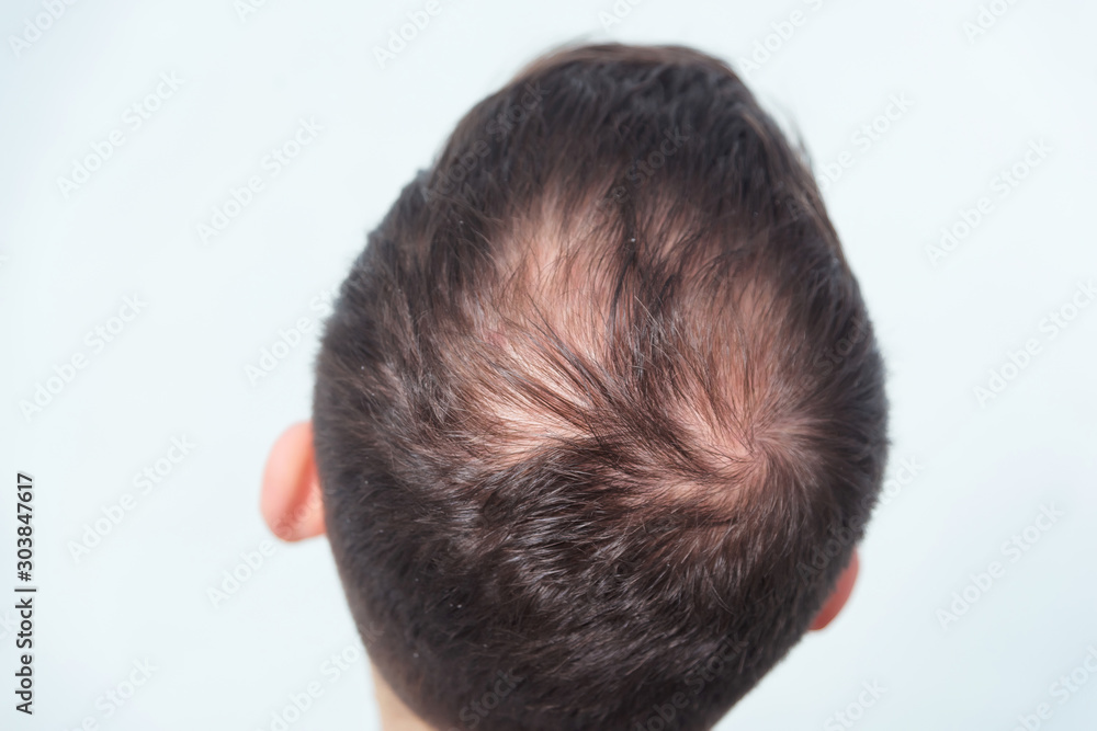 Early male pattern baldness. Hair loss in a young man. Beginning bald spot  on the head. Receding hairline on a man's head Stock Photo | Adobe Stock