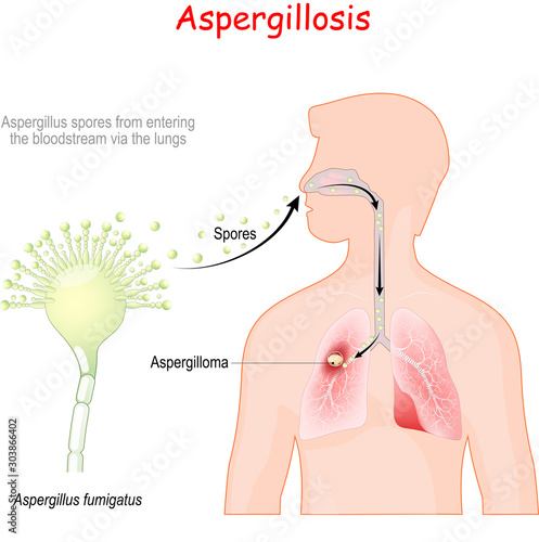 Aspergillosis. life cycle of pathogenic flora. photo