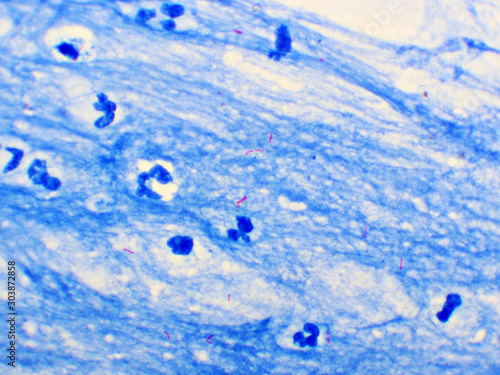 Mycobacterium tuberculosis positive (small red rod) in sputum smear, acid-fast stain, analyze by microscope photo