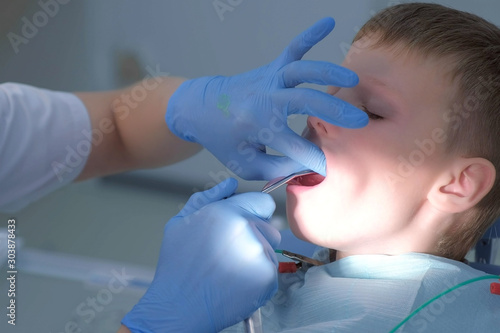 Dentist rinses boy's mouth water holding saliva ejector during oral hygienic cleaning, face closeup, side view. Visit hygienist in stomatology clinic, brushing teeth. Teeth cure and treatment concept.