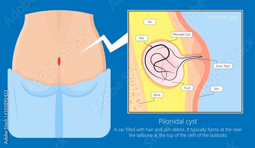 Pilonidal cyst nest of hair causes from excessive prolonged sitting diagnose and treatment