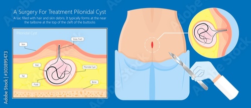Pilonidal cyst nest of hair causes from excessive prolonged sitting diagnose and treatment