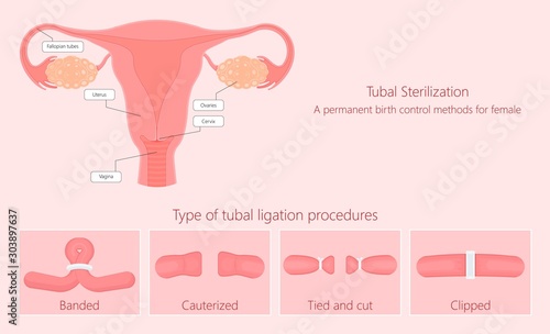 Tubal ligation surgery permanent birth control blocked prevent egg ovary tie uterine banded cauterized sterilizes block photo
