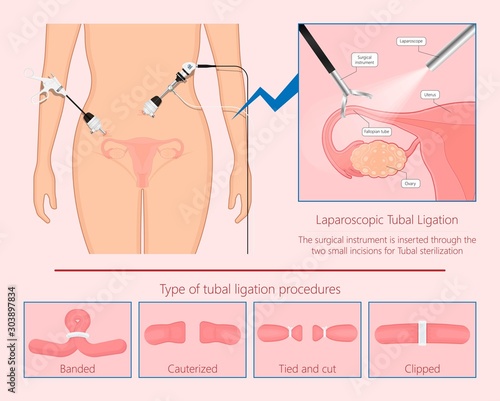 Tubal ligation surgery permanent birth control blocked prevent egg ovary tie uterine banded cauterized sterilizes block photo