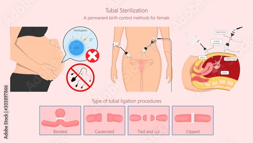 Tubal ligation surgery permanent birth control blocked prevent egg ovary tie uterine banded cauterized sterilizes block