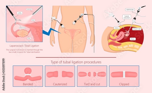 Tubal ligation surgery permanent birth control blocked prevent egg ovary tie uterine banded cauterized sterilizes block