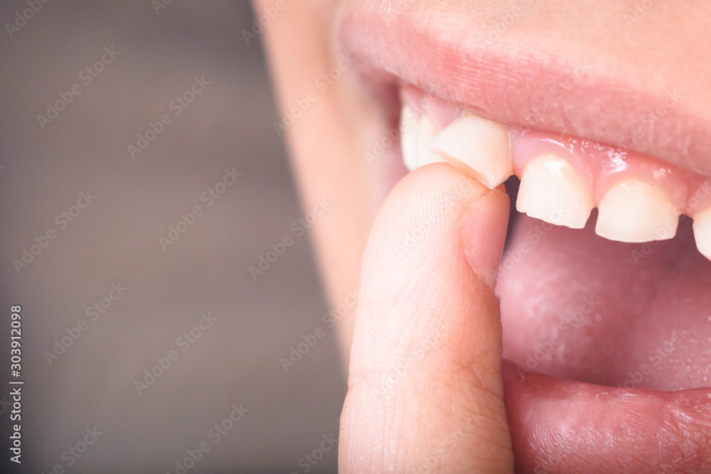 Baby tooth, close-up of the tooth that falls macro shot Baby tooth, close-up of the tooth that falls macro shot