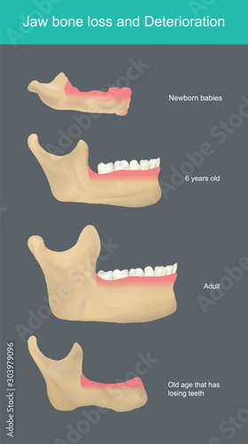 Jaw bone loss and Deterioration.