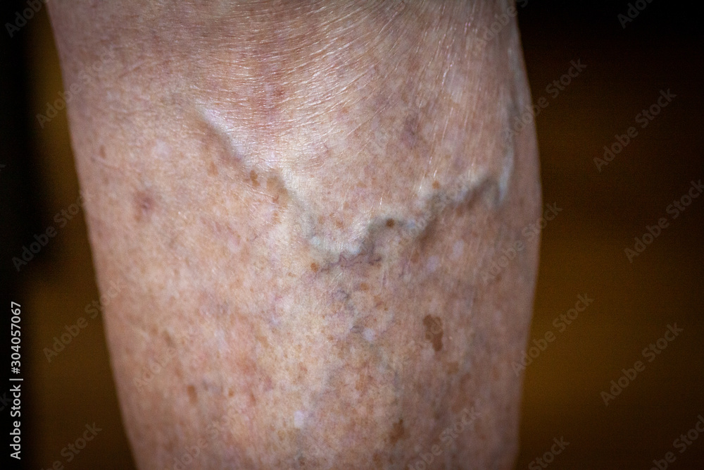 Fototapeta premium closeup feet of old an suffering from leprosy