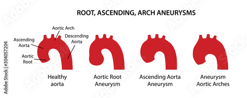 Types of aortic aneurysms: root, ascending, arch. Healthy aorta with main parts labeled and aorta with various types of aneurysm. Vector illustration in flat style isolated on white background