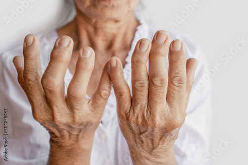 Photos Asian female patient showing hand and fingers problem of gout, joint pain
