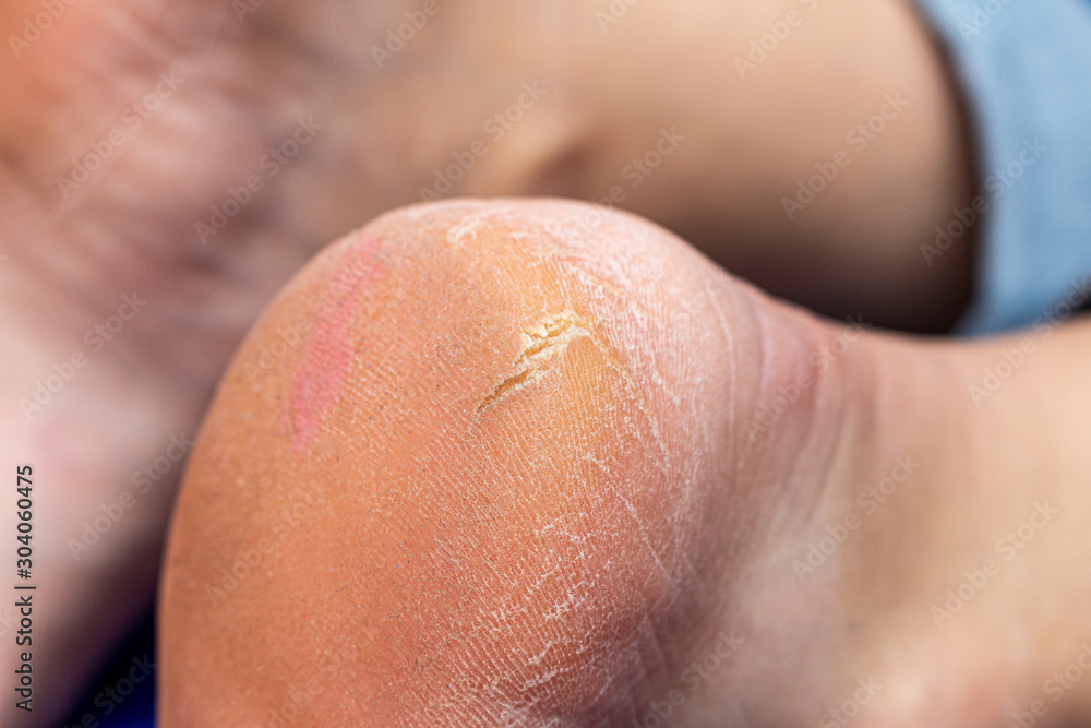 Corn callus cracks on a sole heel foot close up. Dry skin dermatology problem. Corn callus cracks on a sole heel foot close up. Dry skin dermatology problem.