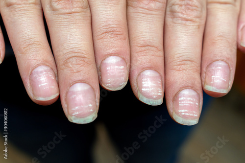 vitamin deficiency avitaminosis anemia nail problem with white dots
