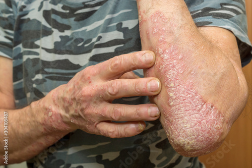 Sick man shows his hands with skin affected by a psoriasis