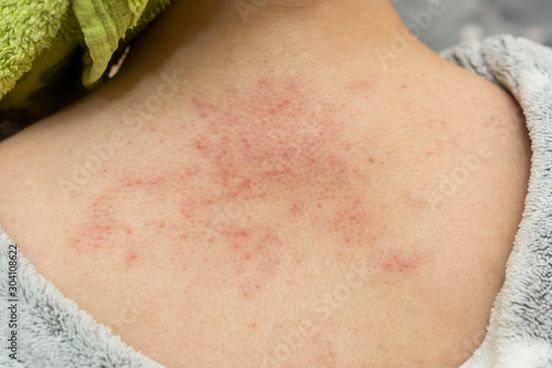 Allergic rash of pimples on the skin of a back photo