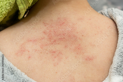 Allergic rash of pimples on the skin of a back