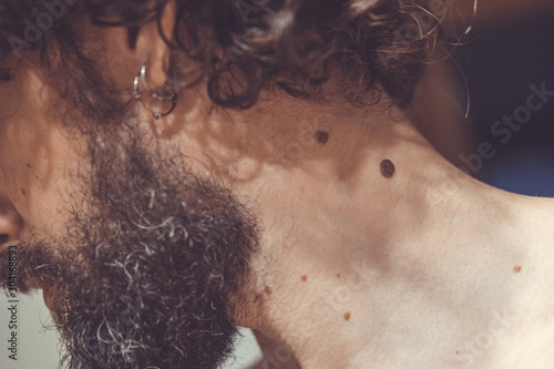 Foto Melanocytic nevus, some of them dyplastic or atypical, on a caucasian man of 37