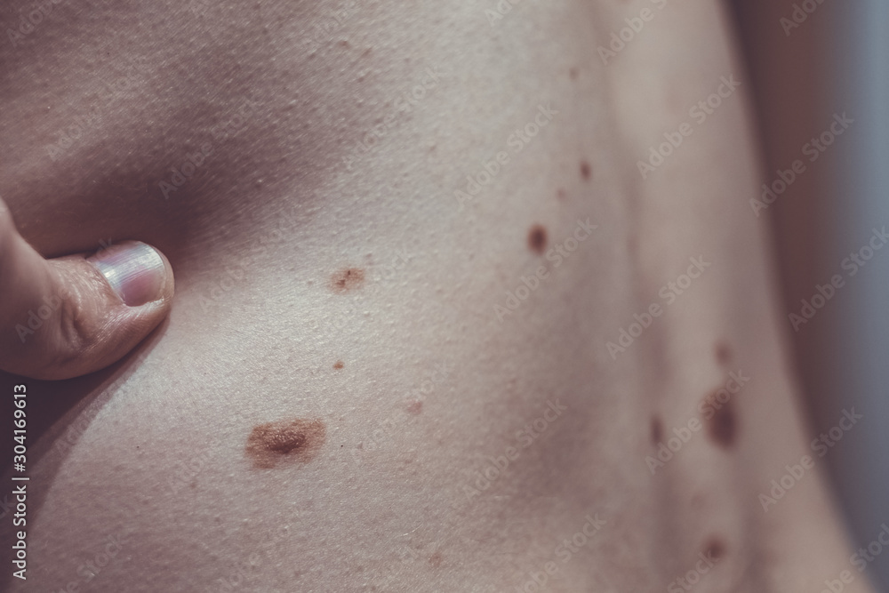 Melanocytic nevus, some of them dyplastic or atypical, on a caucasian man of 37 years old from Spain Melanocytic nevus, some of them dyplastic or atypical, on a caucasian man of 37 years old from Spain