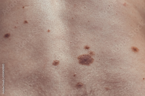 Melanocytic nevus, some of them dyplastic or atypical, on a caucasian man of 37 years old from Spain