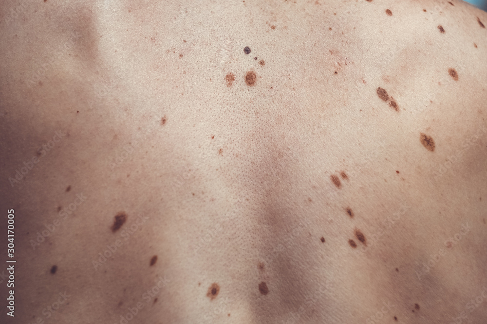 Melanocytic nevus, some of them dyplastic or atypical, on a caucasian man of 37 years old from Spain Melanocytic nevus, some of them dyplastic or atypical, on a caucasian man of 37 years old from Spain