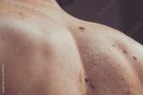 Melanocytic nevus, some of them dyplastic or atypical, on a caucasian man of 37 years old from Spain photo