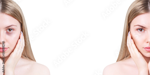 Young woman with bruises under eyes before and after treatment. Copy space.