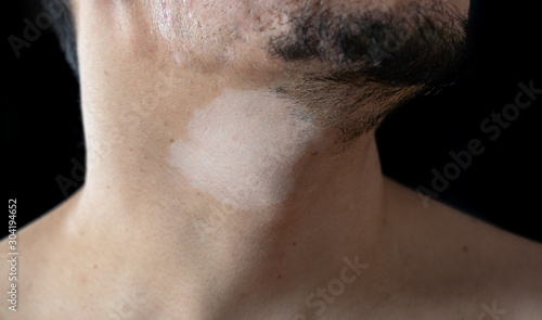 White men with hypopigmentation, white patches without pigment on neck