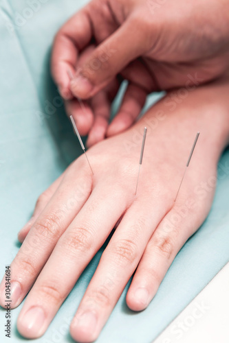 Chinese medicine treatment with acupuncture on the hand photo