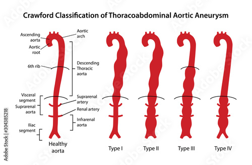 Crawford Classification of Thoracoabdominal Aortic Aneurysms. Healthy aorta with main parts labeled and aorta with four types of Thoracoabdominal aneurysm. Vector illustration in flat style photo