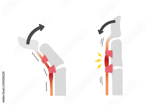 Trigger finger causes and symptoms illustration / No text