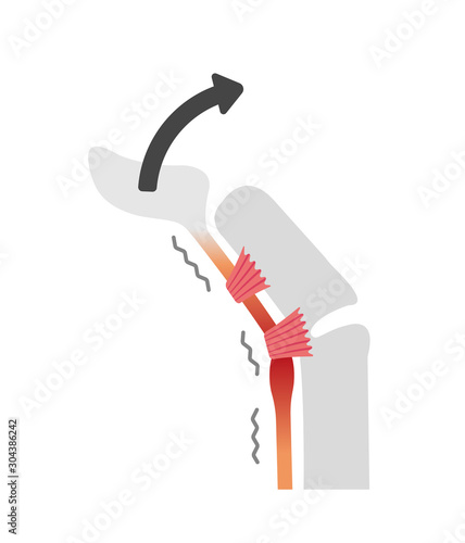 Trigger finger causes and symptoms illustration / when stretching
