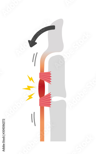 Trigger finger causes and symptoms illustration / when bending