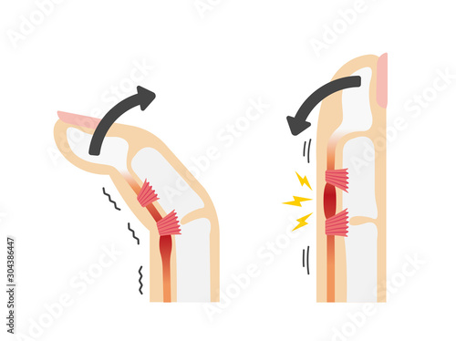 Trigger finger causes and symptoms illustration / No text