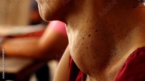 Asian woman patient have abnormal enlargement of thyroid gland Hyperthyroidism at the throat