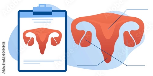 Gynecology, female health. Uterus, ovary and womb. Medical treatment. Endometriosis, endometrium dysfunctionality, endometriosis treatment concept. Doctor make uterus examination. For banner, web page