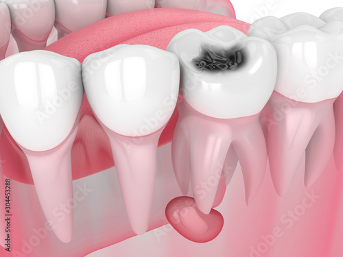 3d render of jaw with tooth cavity and cyst photo