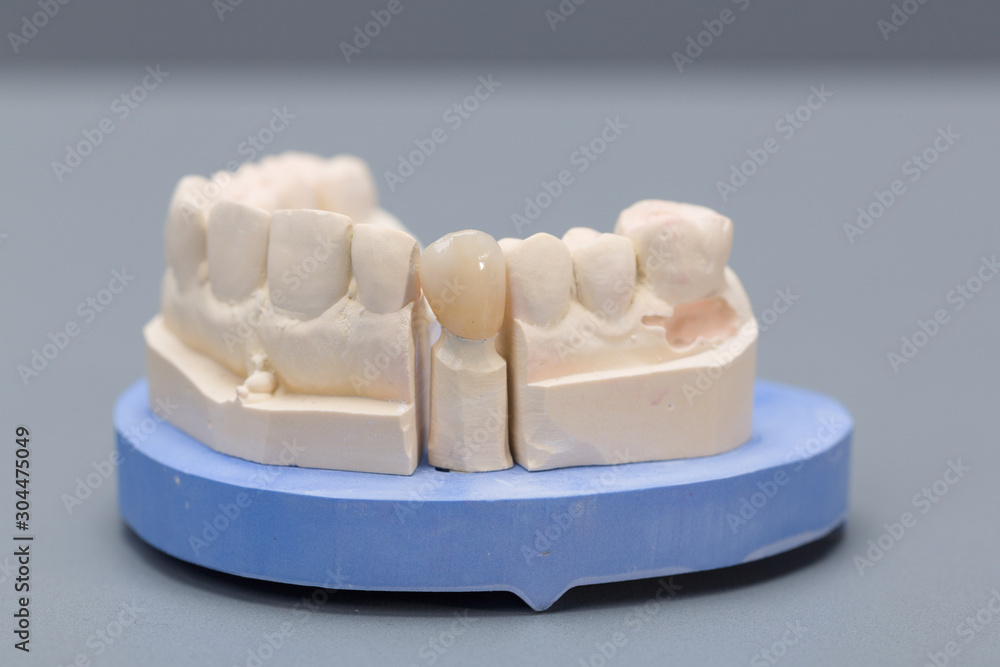 close up of a dental imprint with artificial canine tooth on a dental laboratory workbench close up of a dental imprint with artificial canine tooth on a dental laboratory workbench