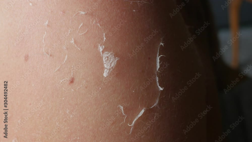 sunburn, flaky skin, man scratching his back sunburn, flaky skin, man scratching his back