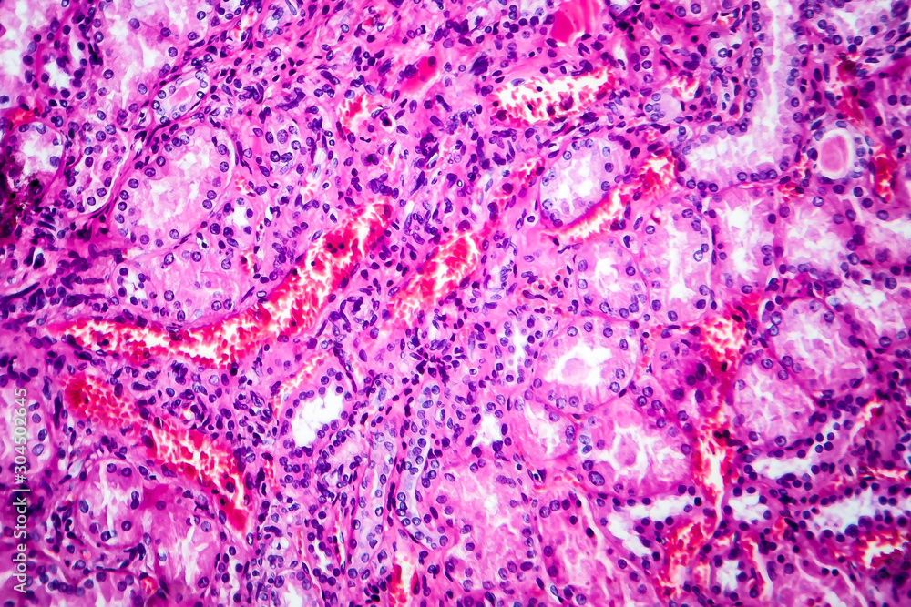 Histopathology of hypertensive renal disease, light micrograph, photo under microscope Histopathology of hypertensive renal disease, light micrograph, photo under microscope