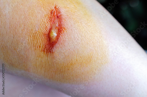 Принти на полотні Close-up of a wound with pus in a person
