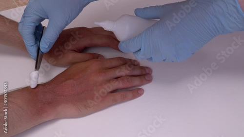 A doctor or nurse wearing gloves removes burnt skin with medical instruments, tweezers from the patient hands. Close-up view. 4k footage.