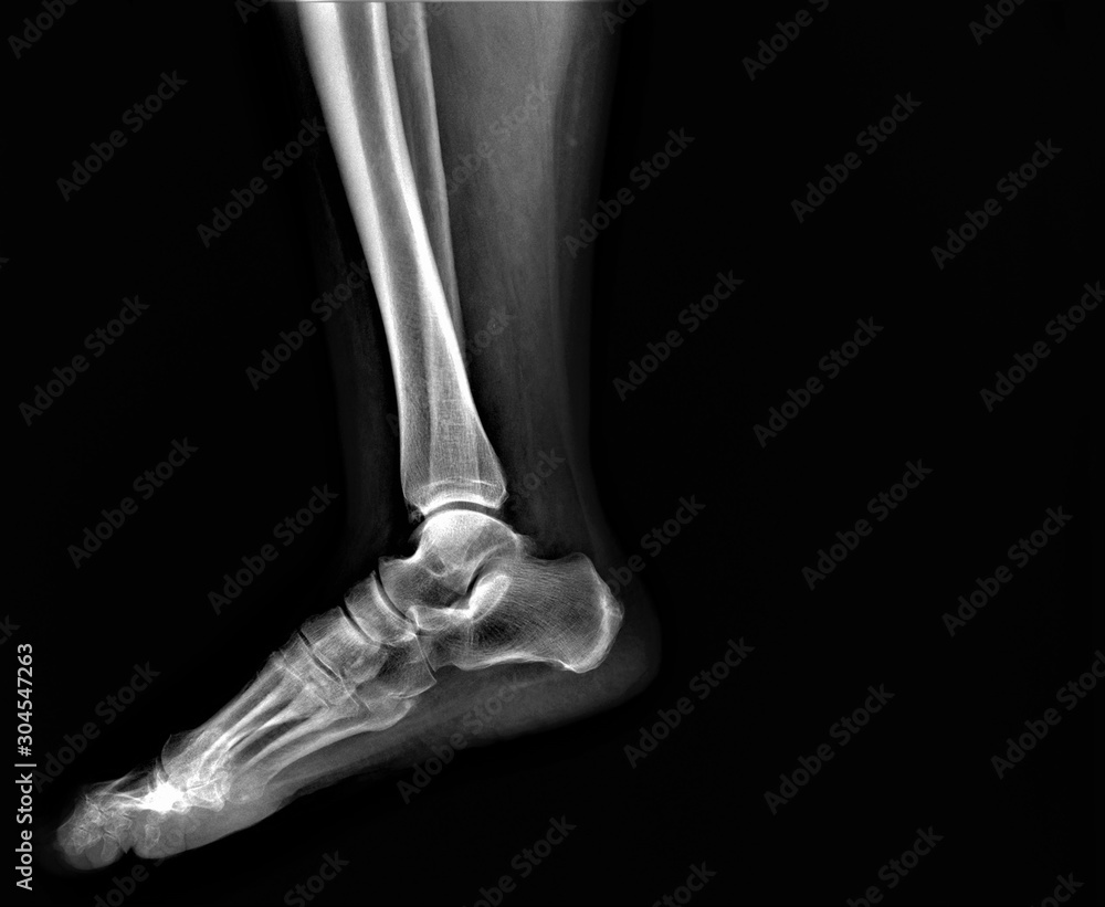 normal radiography of the ankle joint in lateral projection