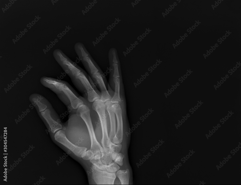 normal radiography of the shoulder joint and ribs in direct projection, Traumatology and orthopedics, traumatology, sports injury normal radiography of the shoulder joint and ribs in direct projection, Traumatology and orthopedics, traumatology, sports injury