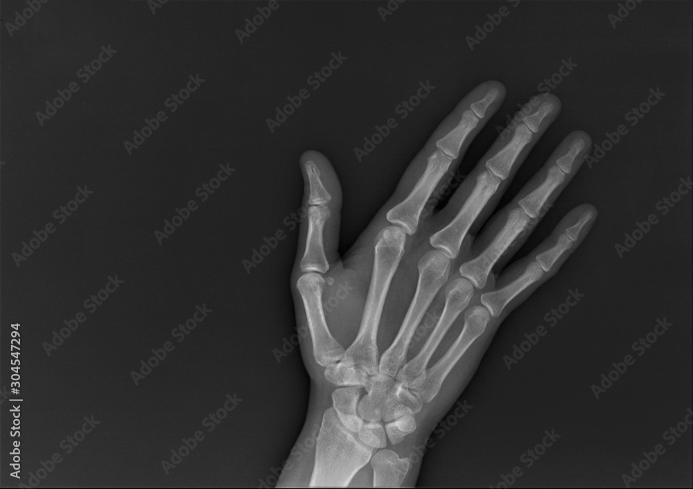 normal radiography of the shoulder joint and ribs in direct projection, Traumatology and orthopedics, traumatology, sports injury
