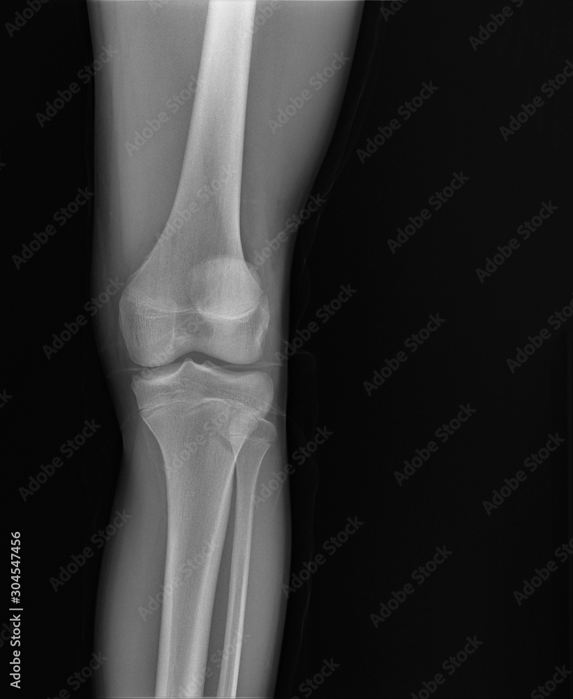 normal radiography of the knee joint in lateral projection, medical diagnostics, traumatology and orthopedics normal radiography of the knee joint in lateral projection, medical diagnostics, traumatology and orthopedics