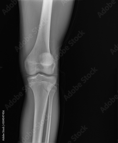 normal radiography of the knee joint in lateral projection  medical diagnostics  traumatology and orthopedics