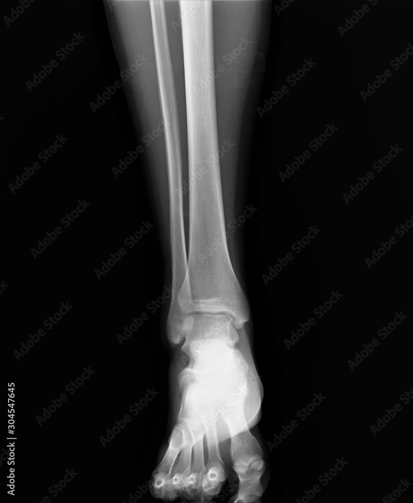 normal radiograph of the ankle joint in front projection,osteoarthritis osteoporosis normal radiograph of the ankle joint in front projection,osteoarthritis osteoporosis