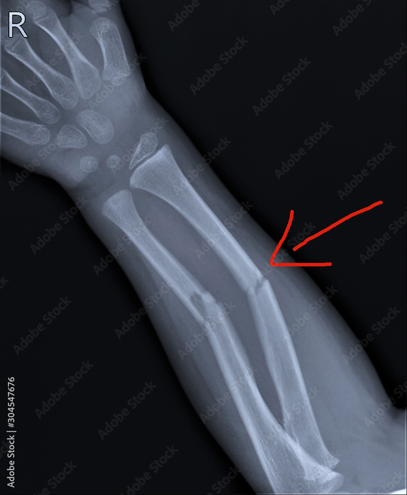radiography of the forearm with a fracture of the radius and ulna ...