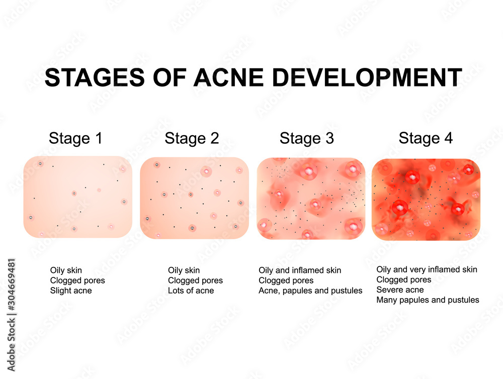 Stages of development of acne. Inflamed skin with scars, acne and